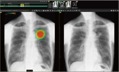 CXR-AID