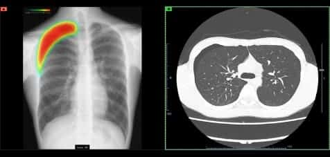 CXR-AID