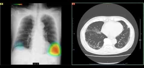 CXR-AID